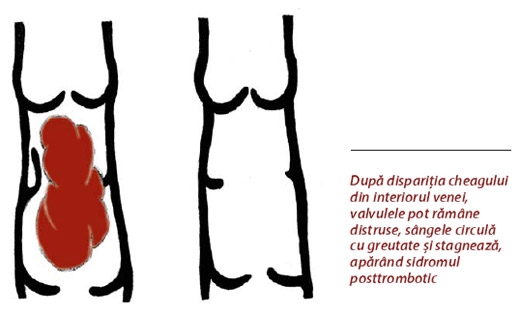 Ce factori genereaza tromboza venoasa?